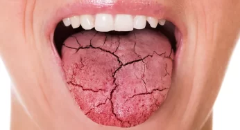 Radioterapi Kanker Sebabkan Mulut Kering, Apa Solusinya?